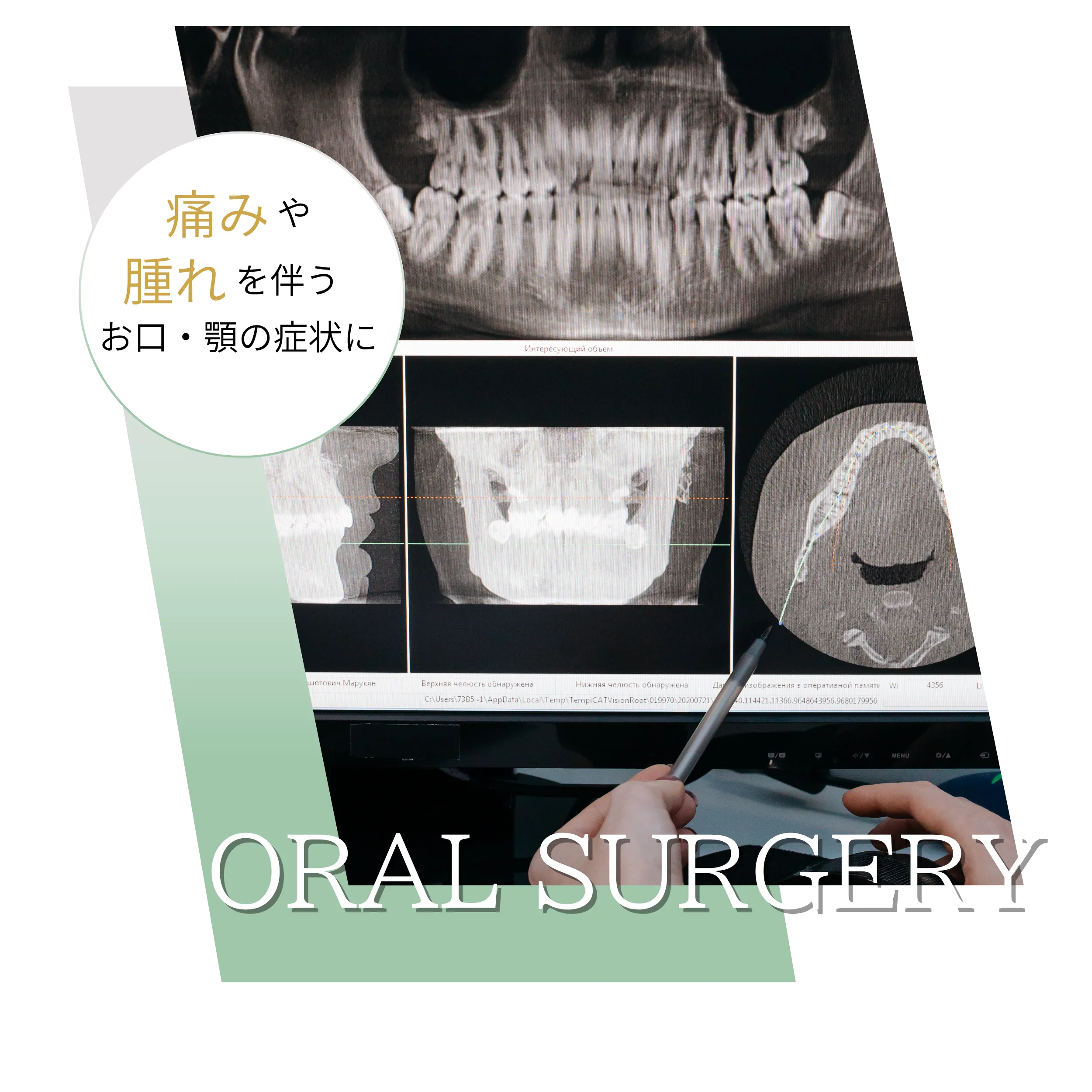 親知らず抜歯・口腔外科